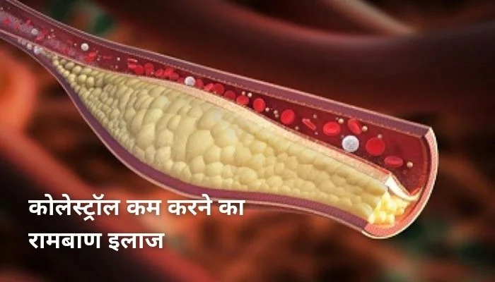 कोलेस्ट्रॉल कम करने का रामबाण इलाज | Cholesterol Kam Karne Ke Upay