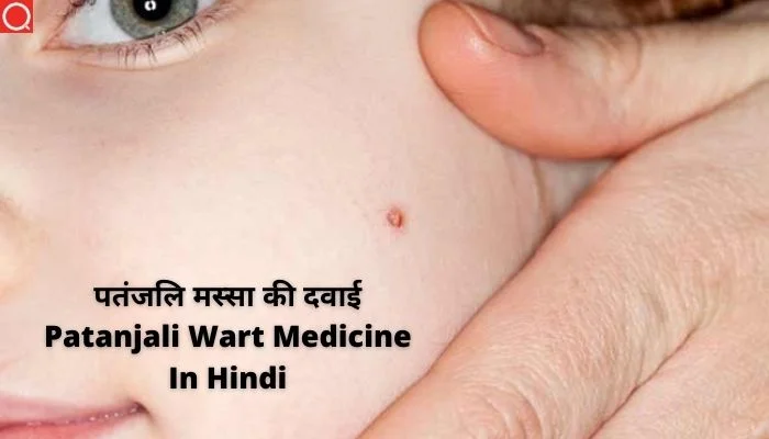 पतंजलि मस्सा की दवाई | मस्से हटाने की दवा | Patanjali Wart Medicine