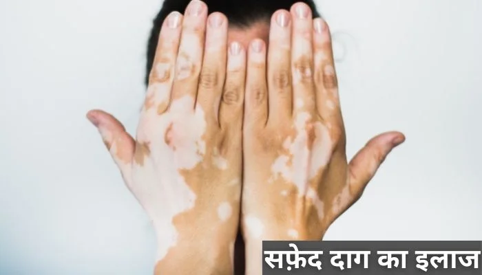 Safed Daag Ka Ilaaj | सफ़ेद दाग का इलाज