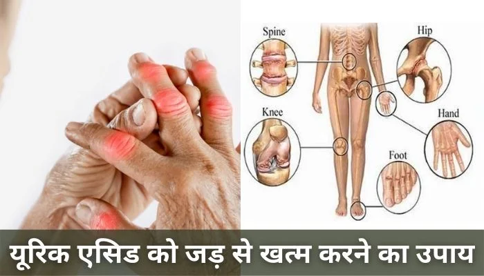 यूरिक एसिड को जड़ से खत्म करने का उपाय